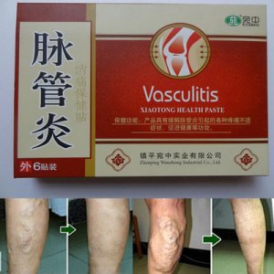 風濕脈管炎貼OEM代加工